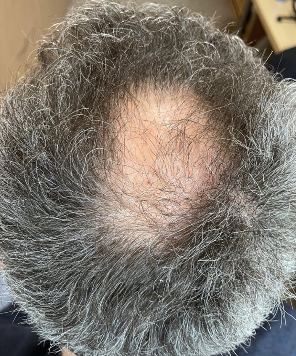 Top of head with dark gray, curly hair; pronounced bald spot at the crown, irregular hairline around the tonsure