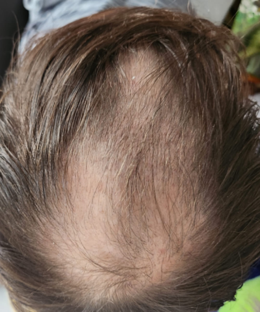 Top of head of a man with a distinct tonsure; thinning hair at the crown, a lot of scalp visible