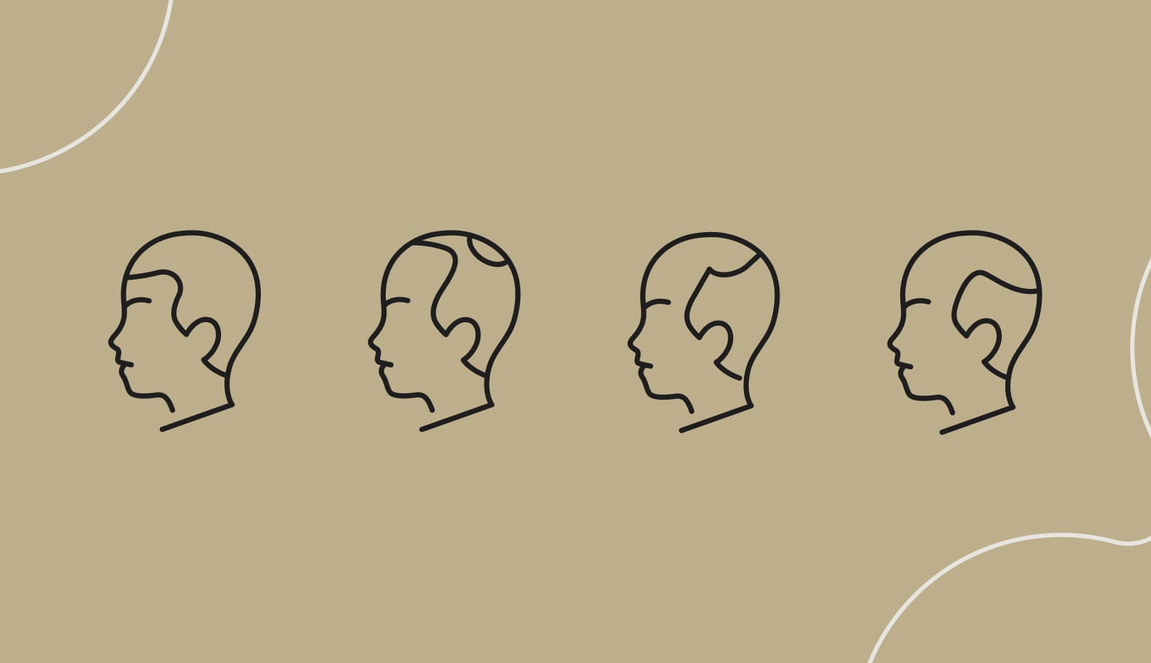 Visualization of different types of hair loss using a male head as an example
