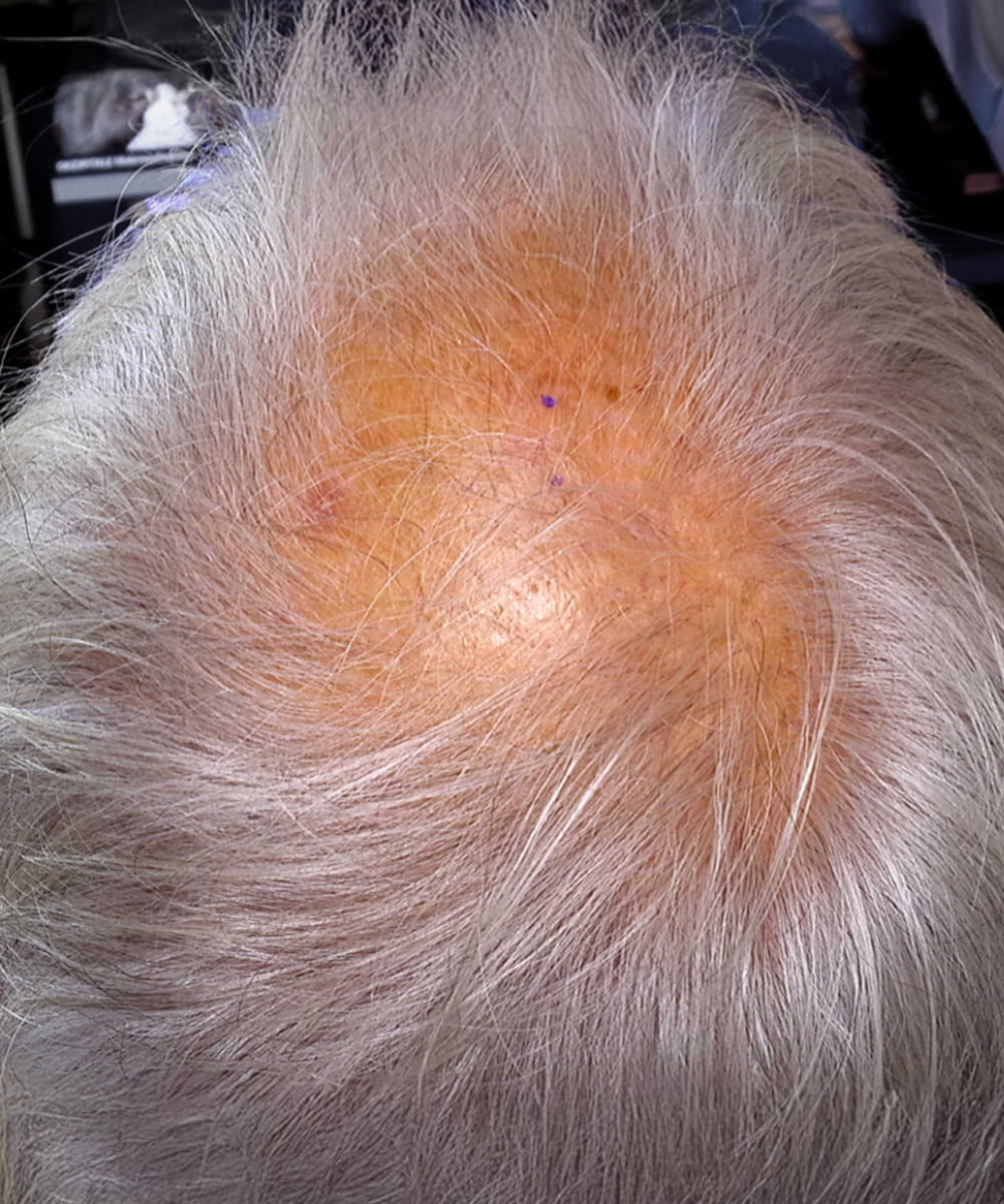 Top of head with gray/white hair; large round thinning at the crown, irritated reddish scalp shines through
