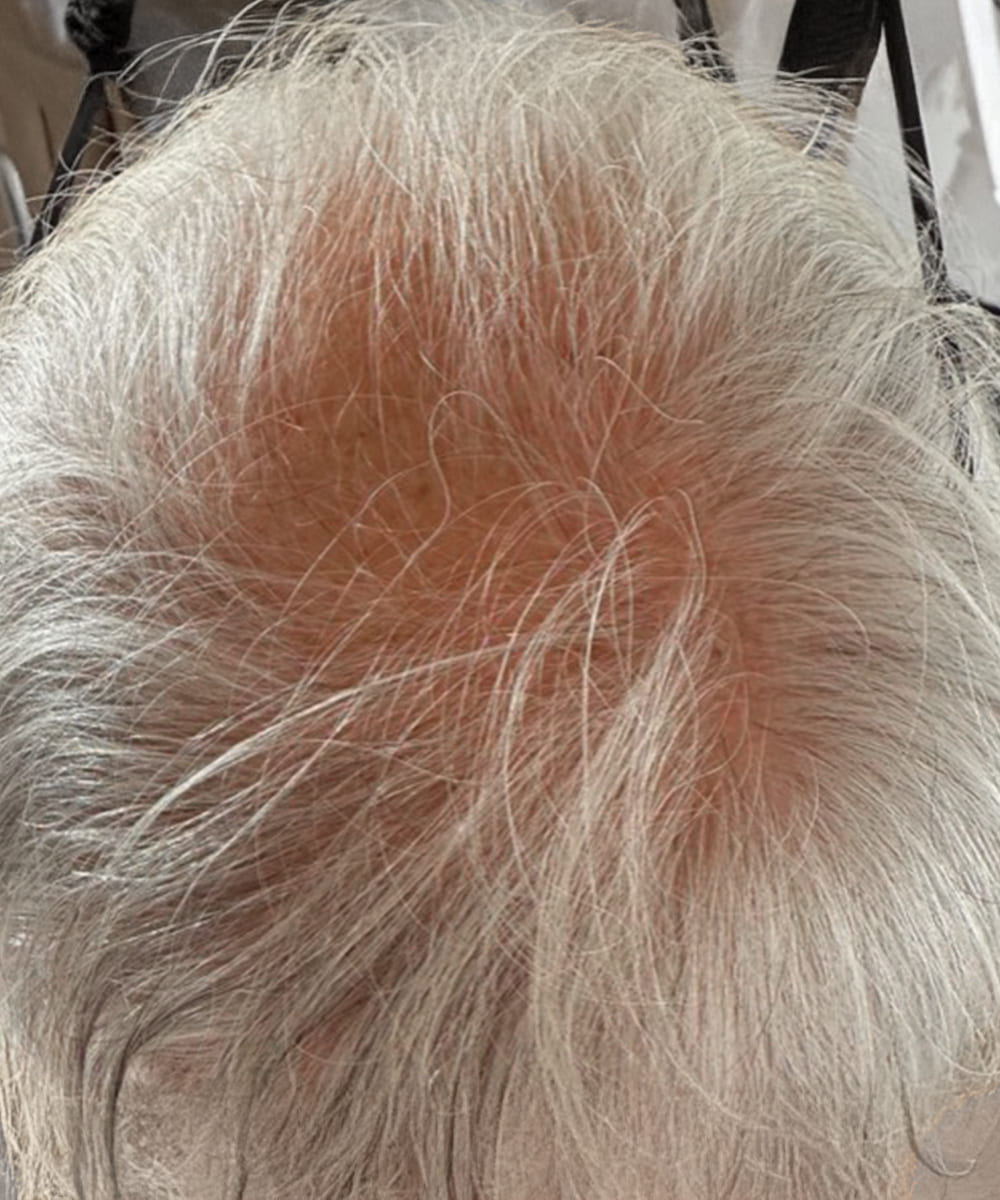Top of head with gray/white hair; increased hair volume at the crown, reduced redness, scalp less visible