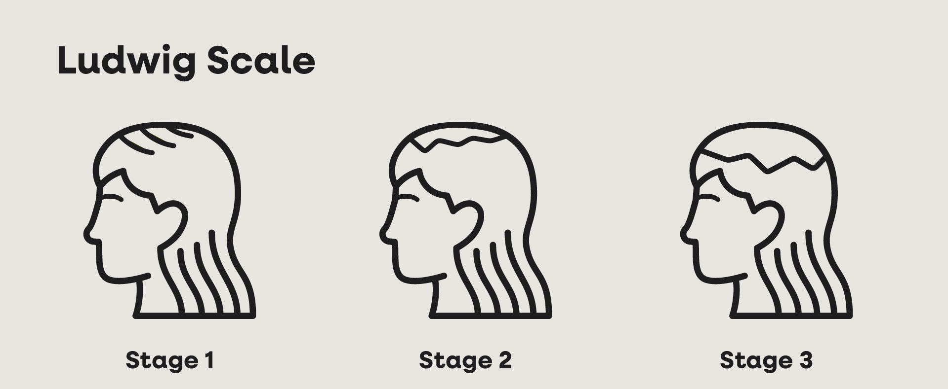 Ludwig scale infographic with three icons (Stage 1–3) illustrating increasing hair thinning