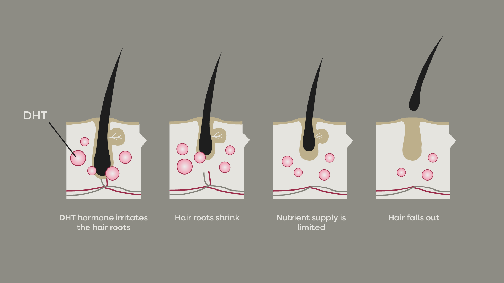 Four-step infographic: DHT irritates the hair roots, hair roots shrink, nutrient supply is limited, hair falls out.
