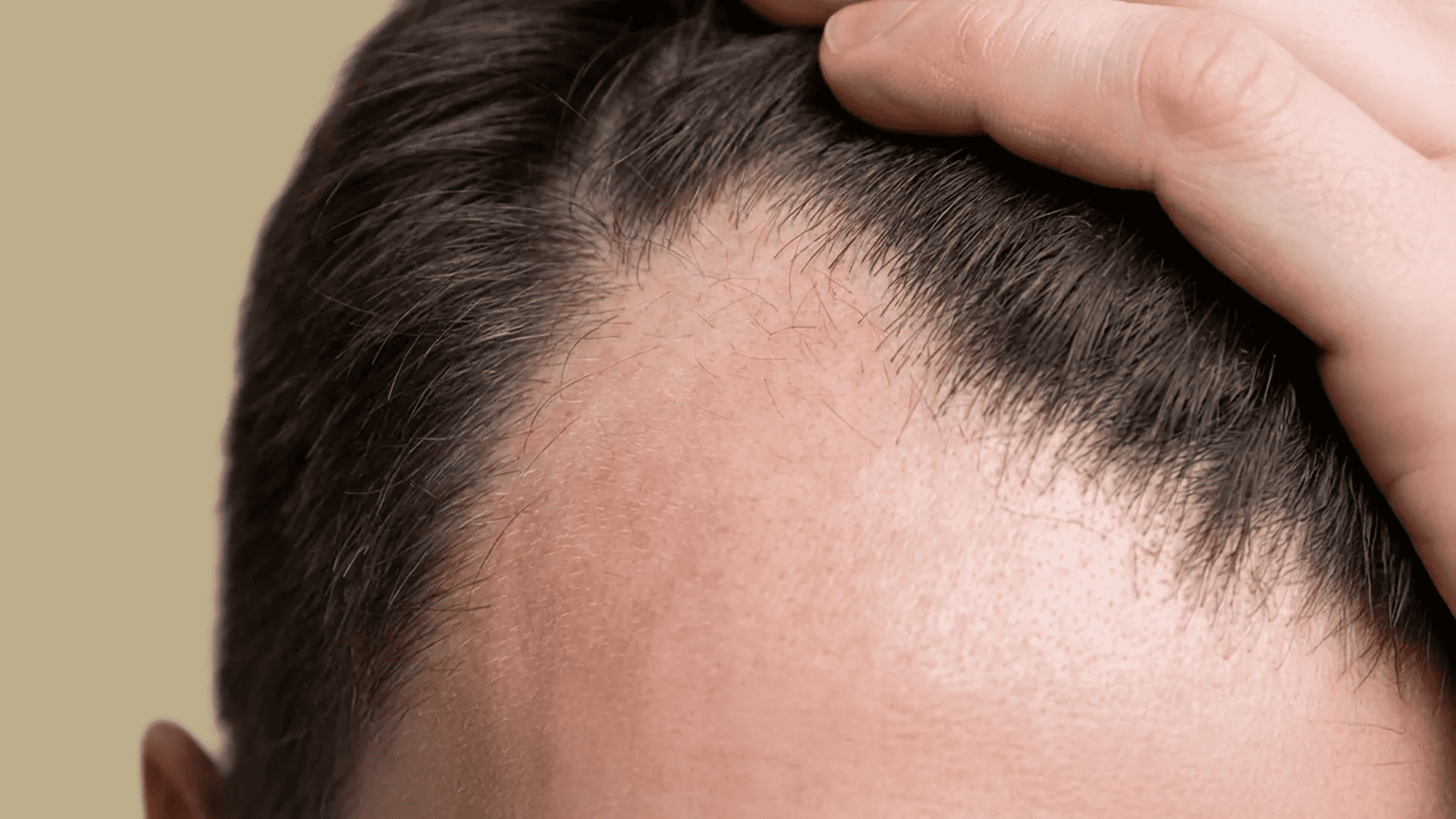 Nahaufnahme: Hand zieht Haare zurück und zeigt einen zurückweichenden, ausgedünnten Haaransatz.Nahaufnahme: Hand zieht Haare zurück und zeigt einen zurückweichenden, ausgedünnten Haaransatz.