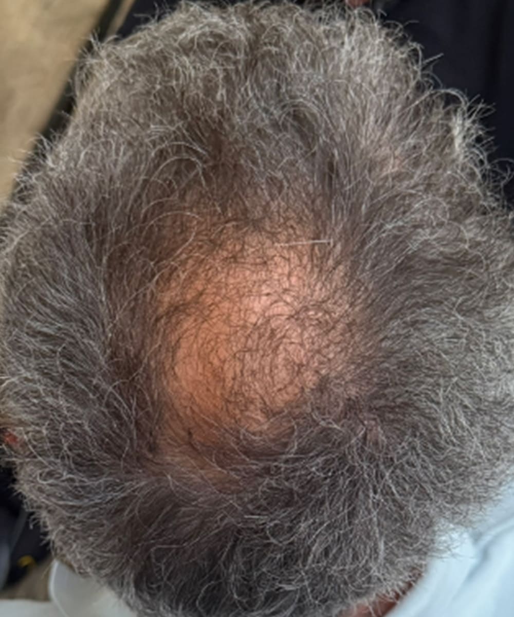 Top of head with dark gray, curly hair; denser growth at the crown, significantly smaller bald spot, more coverage